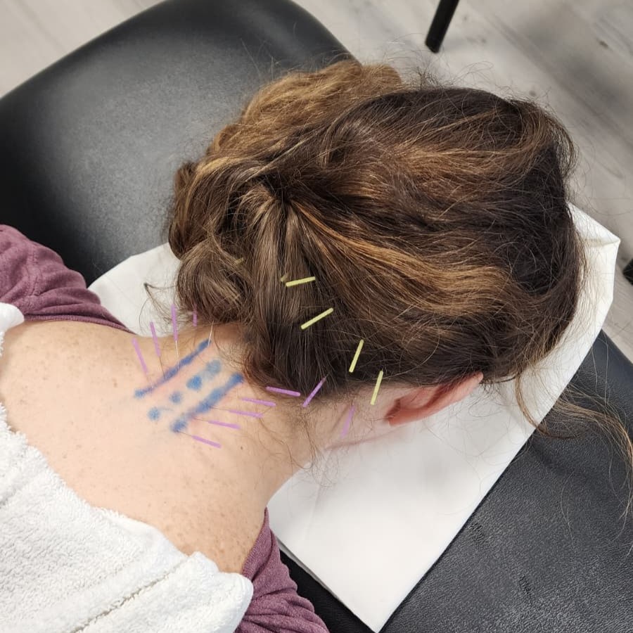 dry needling neck pain woman cropped